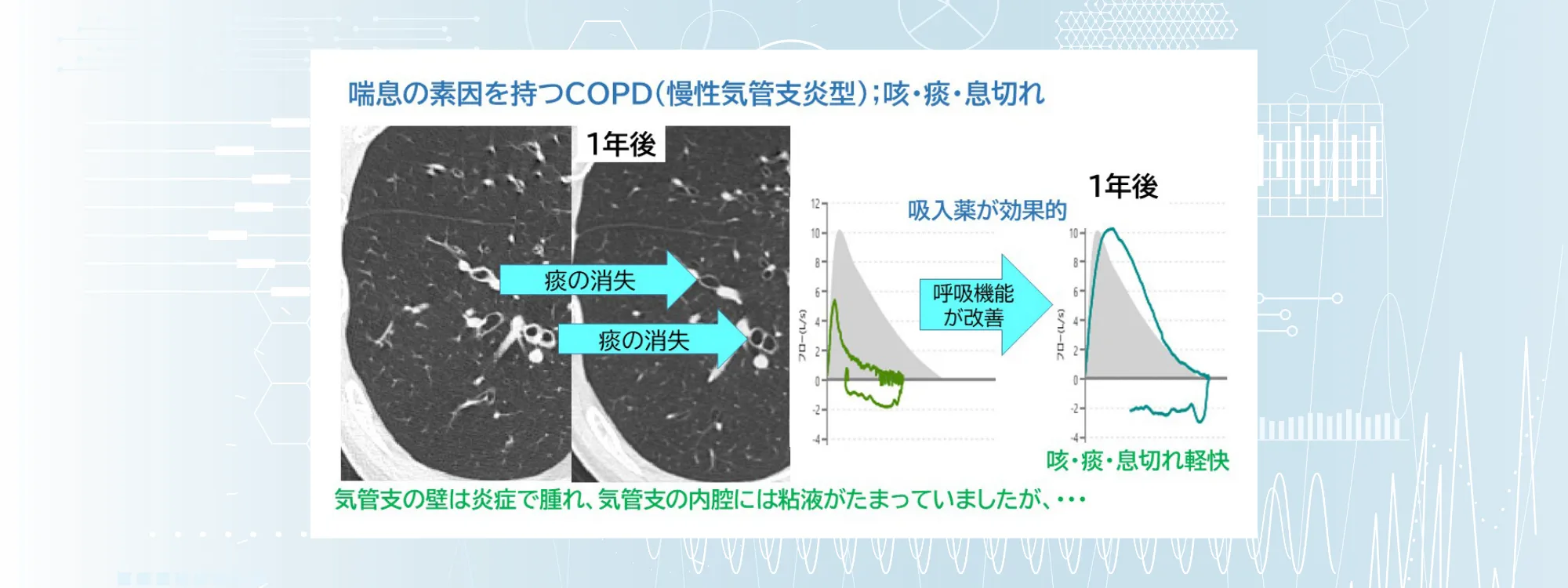 長引く咳の原因